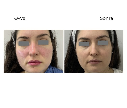 Candela Vbeam Perfecta